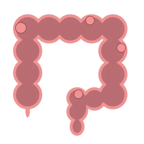 大腸ポリープの切除について